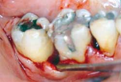 Figura 11. Foto clínica mostrando proyección de esmalte clase III, a nivel del primer molar inferior derecho.