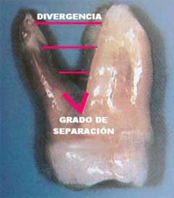 Figura 2. Fotografía que ilustra el grado de separación y divergencia entre las raíces mesio-vestibulares y palatina de un molar superior. Tomado de Lindhe 2000.