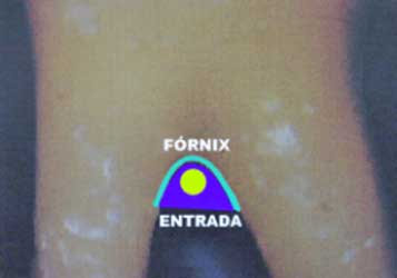 Figura 3. Vista vestibular de la entrada de la furcación y de su techo. Tomada de Lindhe 2000.