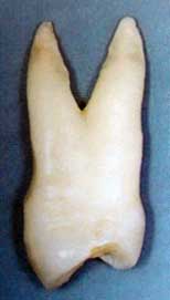 Figura 6. Primer Premolar Superior con la furcación en el tercio apical del complejo radicular. Tomado de Lindhe 2000.