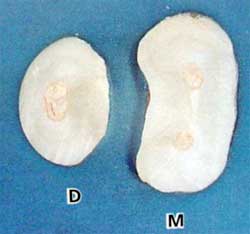 Figura 7. Forma en reloj de arena de la raíz mesial, con una concavidad en la cara distal y forma circular de la raíz distal. Corte horizontal. Tomado de Lindhe 2000