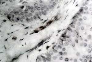 Fig. 1. Expresión del FVIII/vWF en un vaso sanguíneo de una lesión de displasia leve. Barra= 10 mm.