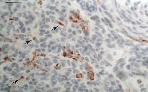 Fig. 3. Expresión del FVIII/vWF en los vasos sanguíneos y brotes vasculares (flechas) de una lesión de displasia severa. Barra= 10 mm.