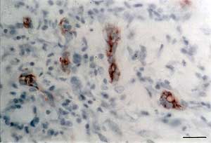 Fig. 4. Expresión del FVIII/vWF en los vasos sanguíneos de un carcinoma espinocelular. Barra= 10 mm.