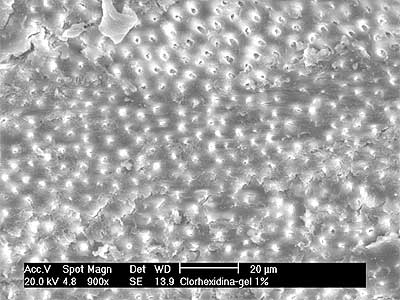 Fig. 2. Gel de clorhexidina al 1%. Tercio Medio