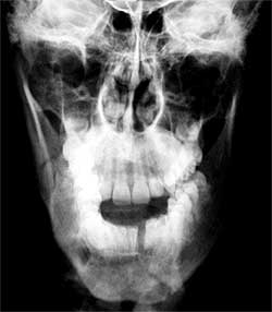 Fig. 2: Radiografía P.A frontal preoperatoria, donde se observan imágenes compatibles con las fracturas a nivel de parasinfisis izquierda y ángulo mandibular derecho.
