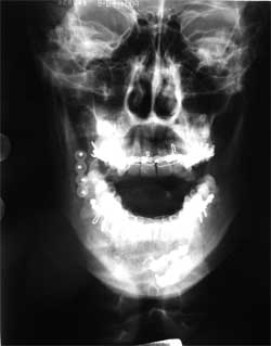 Fig. 6: Radiografía P.A frontal post-operatoria. Puede observarse la reducción anatómica y fijación de las fracturas.