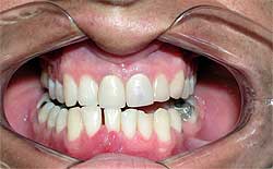 Fig. 7: Imagen clínica preoperatória observándose el dislocamiento a nivel de la arcada mandibular,, asi como la alteración de la oclusión del paciente.