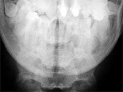 Fig. 8: Radiografia P.A frontal preoperatória