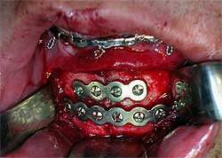 Fig. 9: Imagen clínica transoperatoria, observándose la FIR de la fractura de sínfisis mandibula por medio de placas y tornillos del sistema de fijación 2.0 mm.