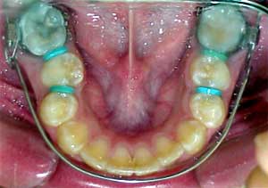 FIG. 1. Lip Bumper de alambre. Cortesía de: Zalnieriunas, A. Postgrado de Ortodoncia Facultad de Odontología U.C.V. (2.000 - 2.003)