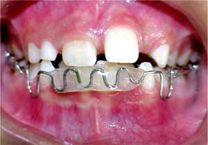 FIG. 2. Lip Bumper cubierto con material plástico Cortesía de: Zalnieriunas, A. Postgrado de Ortodoncia Facultad de Odontología U.C.V. (2.000 - 2.003)