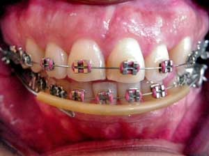 FIG. 3 Lip Bumper ligado a tubos de bandas molares Cortesía de: Lozada O. Postgrado de Ortodoncia Facultad de Odontología U.C.V. (2.000 - 2.003)