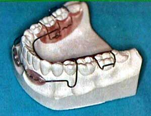 FIG.4 Lip Bumper removible combinado con arco lingual. Tomado de: Quirós, O. (1.993) 37