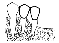 Fig N° 2: El pilar más distal tiene pérdida de soporte de más de 50%.