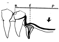 Fig. N° 3: El diente pilar con la cofia para sobredentadura parcial se constituye en un fulcrum de una palanca clase, sometiendo al pilar a fuerzas de inclinación distal, aún con al utilización de un retenedor tipo gancho.