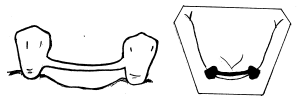 Fig N° 5: Barra ferulizadora en caso mandibular.