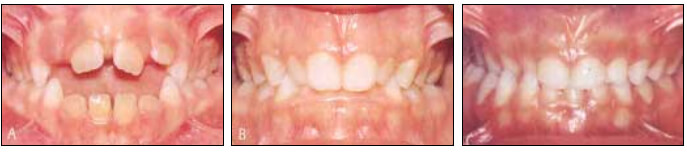 Fig. 7. A: Mordida Abierta; B : Mordida Profunda; C: Mordida Cruzada. Tomado de Varela 1999