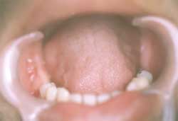 Figura 2. Aspecto intrabucal