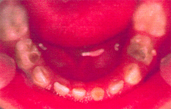 Maxilar Inferior Antes del Tratamiento