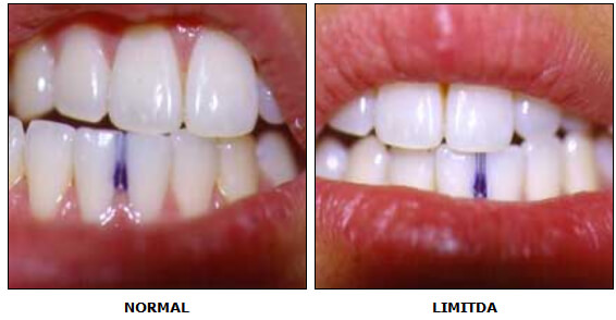 Fig. 2 LATEROTRUSION Iz. Y Dr.