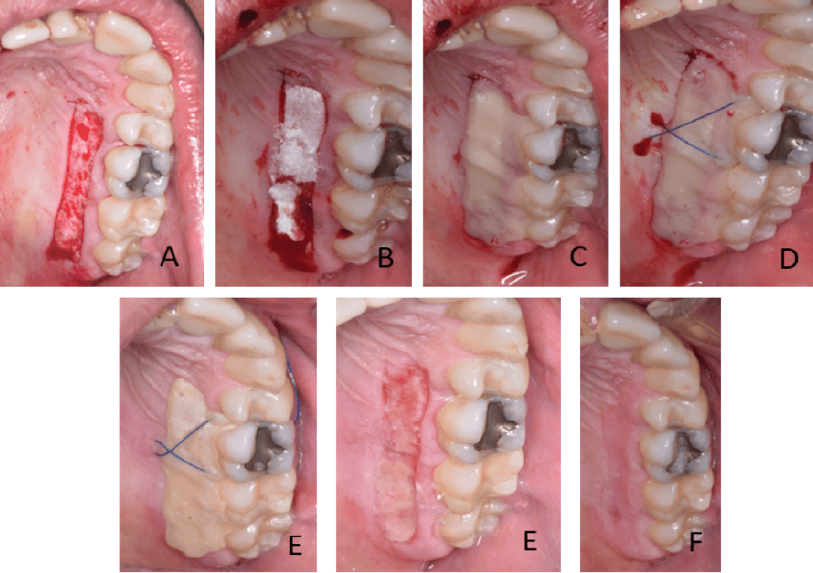 Figura 1. Paciente masculino: A: zona donante. B: esponja de colágeno. C: matriz de resina fluida fotopolimerizable. D: matriz de resina y sutura. E postoperatorio 7 días. F: postoperatorio 14 días.