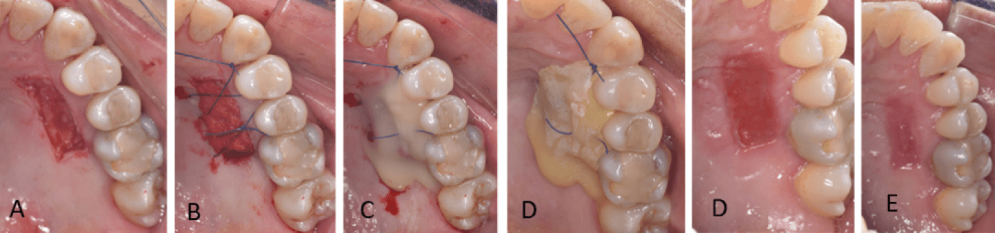 Figura 2. Paciente femenino: A: zona donante. B: esponja de colágeno y sutura. C: matriz de resina fluida fotopolimerizable. D: postoperatorio 7 días. E: postoperatorio 14 días.