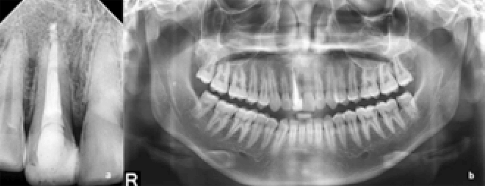 Figura 10. Radiografías controles a los 24 meses (a) Radiografía periapical digital (b) Radiografía panorámica