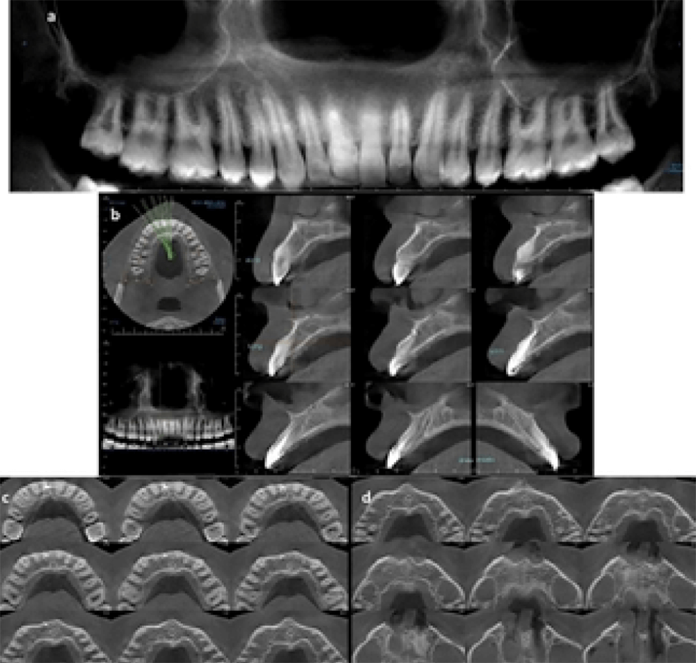 Figura 11. CBCT control a los 2 años. (a) reconstrucción panorámica de la lesión periapical (b) cortes sagitales secuenciales de la unidad dentaria 1.1, (c) y (d) cortes axiales secuenciales del maxilar superior.