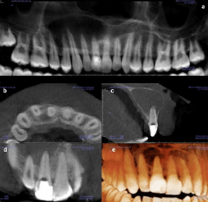 Figura 2. CBCT inicial. (a) reconstrucción panorámica (b) corte axial, (c) corte sagital, (d) corte coronal y (e) reconstrucción 3D de la unidad dental 1.1.