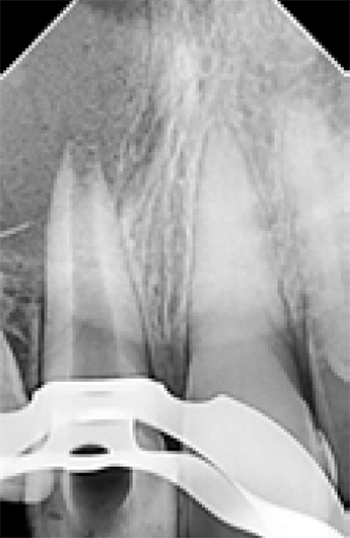 Figura 4. Radiografía control de desobturación unidad dental 1.1.