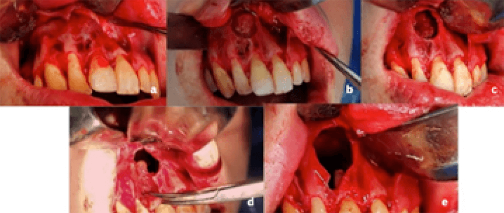 Figura 5. Fotografías transoperatorias (a) levantamiento de colgajo. (b) osteotomía (c) evidencia lesión (d) y (e) enucleación de la lesión