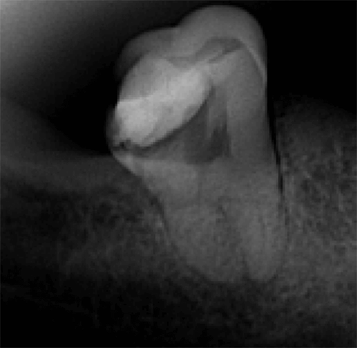 Figura 2. Radiografía inicial previo a realizar la endodoncia.