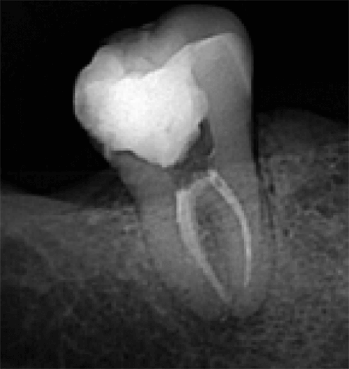 Figura 6. Radiografía de seguimiento 5 meses posteriores.