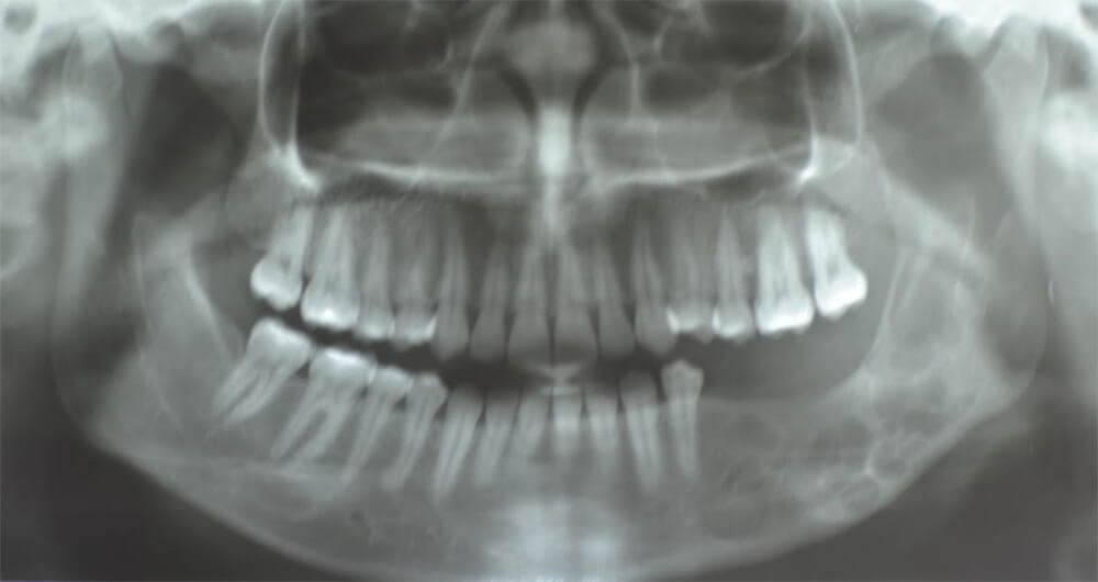 Figura 6. Ortopantomografía 5 años después de la cirugía (año 2018) donde se aprecian múltiples imágenes radiolúcidas en región de cuerpo, ángulo y rama mandibular izquierda sugestivas de recidiva de lesión osteolítica.