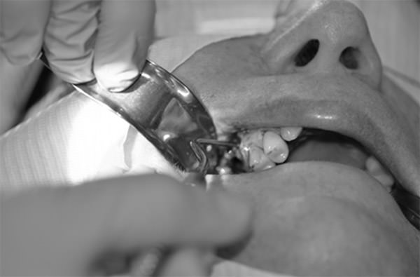 Figura 3 Curetaje para retiro del cuerpo extraño en seno maxilar Fuente propia