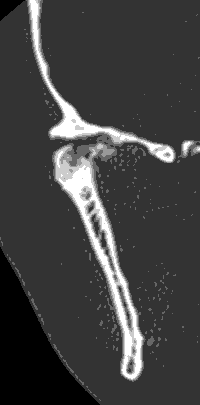 Figura 2 Tomografía computada de ATM derecha, corte coronal: en la imagen se visualiza la gran destrucción de los tejidos óseos destacando la irregularidad de la anatomía condilar y de cavidad glenoidea, presencia de áreas pseudoquísticas en zona alta y visualización de osteofitos en polo medial.