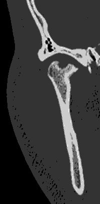 Figura 4: ATM derecha, Tomografía computada corte coronal: se visualiza marcada pérdida de anatomía condilar, con pérdida de estructura ósea central de apex e irregularidad de polo medial.