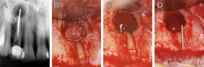 Figura 1 (A) radiografía periapical de diagnóstico; (B) divulsión total del colgajo mucoperióstico mostrando la perforación y la lesión periapical; (C) remoción total de la lesión periapical; (D) instrumentación de la perforación radicular.