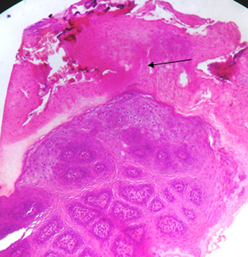 Fig. 2 Hiperplasia Epitelial Exofítica con marcada Paraqueratosis.