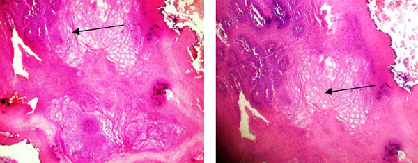 Fig. 3 y 4 Islas de células claras con núcleo borroso y desplazamiento periférico de la cr