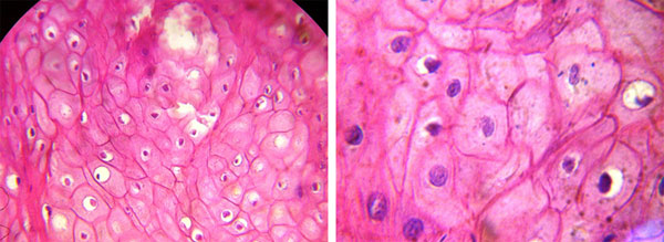 Fig. 5 Células en balón a mayor aumento. 40X Fig. 6 Cuerpos de Cowdry bajo inmersión. 100X
