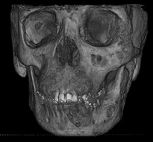 Fig. 3 Reconstrucción 3D