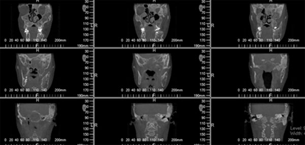 Corte coronal