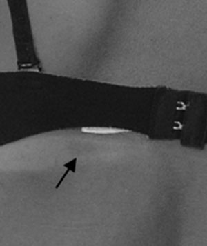 Fig. 5 Vista posterior, detalle de macula cutánea café con leche en región infra escapular izquierda
