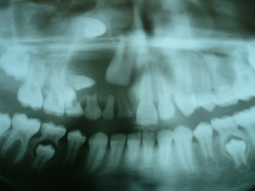Figura 1 Radiografía que muestra tumor maxilar derecho