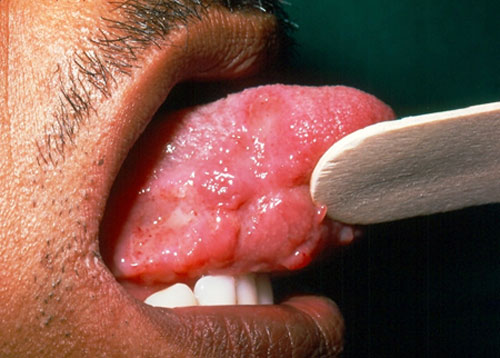 FIGURA 1 Lesión de Histoplasmosis en lengua (Cortesía: Profa. Carmen Marcano, Sección Micología Médica-IMT)