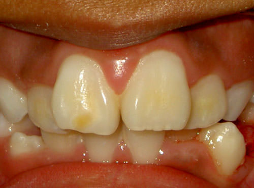 Foto 2 Hipoplasia de esmalte localizada