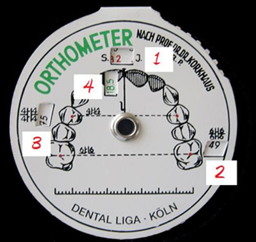 Fig.N°1 Ortómetro de Korkhaus: Suma incisiva. Dimensión transversal a nivel de la fosa mesial de los primeros molares Dimensión transversal a nivel de la fosa central de primeros premolares Longitud anterior, levantada desde de la dimensión transversal consignada en los premolares, perpendicular al centro de la papila de los incisivos centrales