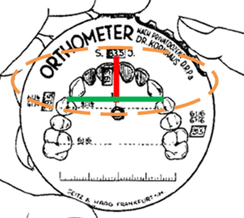 Fig.Nº 2 Mediciones de la dimensión transversal y de la longitud anterior, realizadas sobre el Ortómetro de Korkhaus. En Verde: Medición que se realizó en sentido transversal de la fosa del 1° Premolar a 1° Premolar opuesto. En Rojo: Medida Sagital del segmento anterior